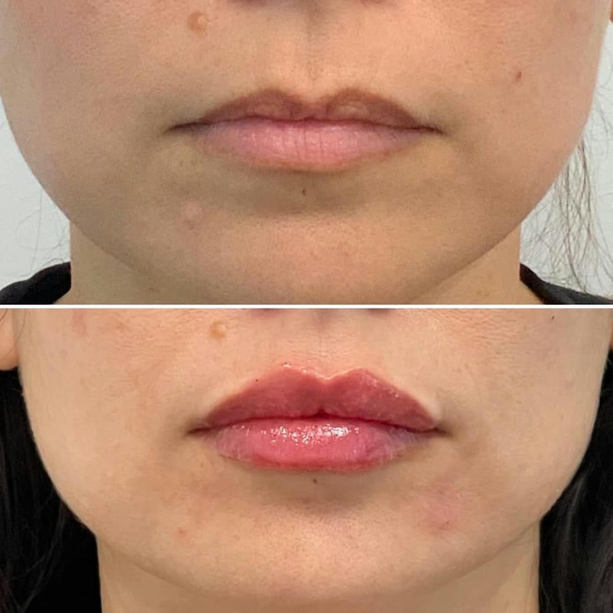 Lip Injections Before & After Gallery - Patient 320456 - Image 1