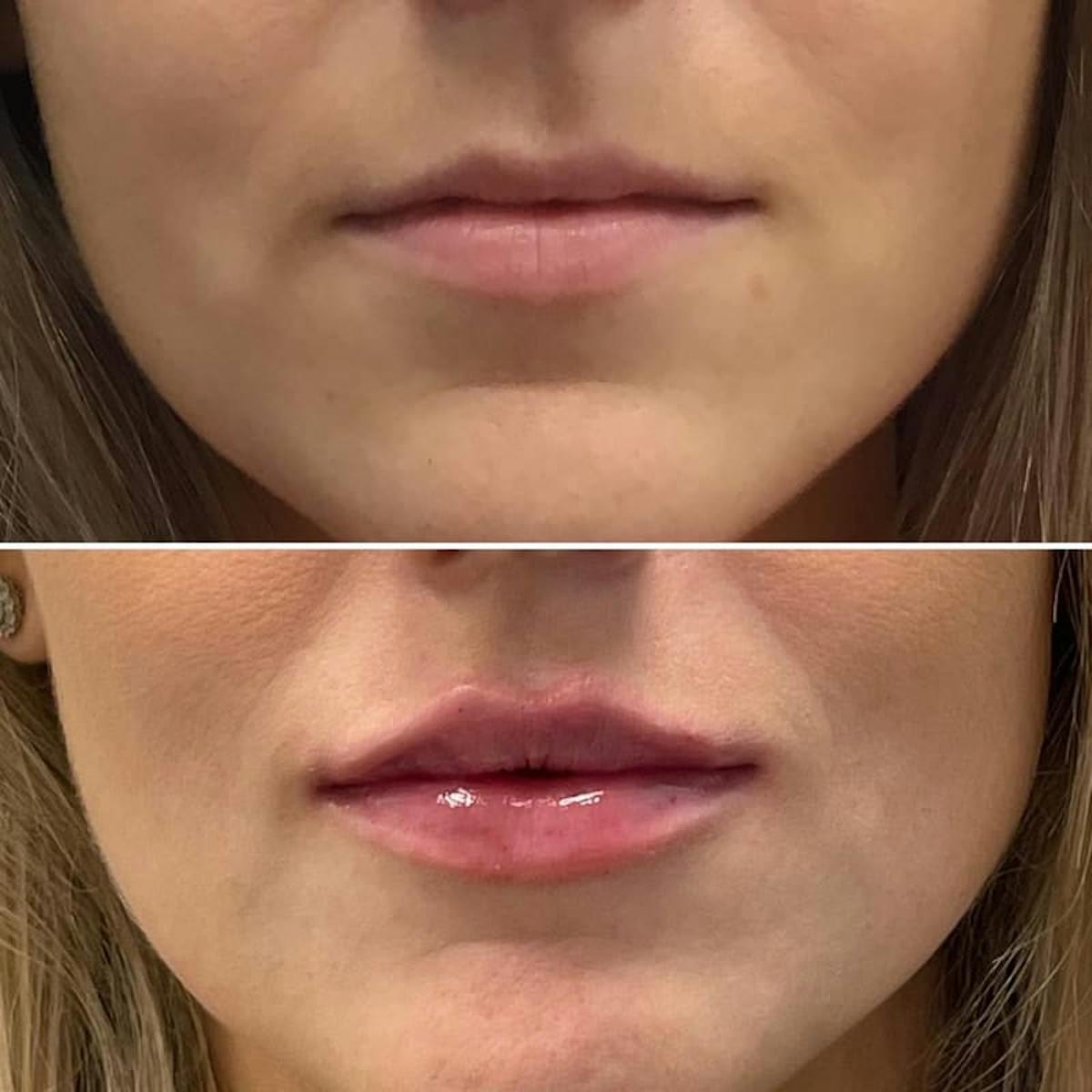 Lip Injections Before & After Gallery - Patient 118181 - Image 1