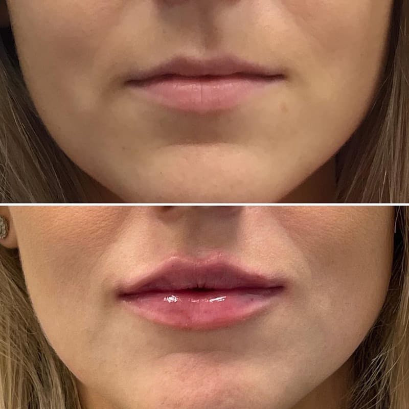 Lip Injections Before & After Gallery - Patient 118181 - Image 1