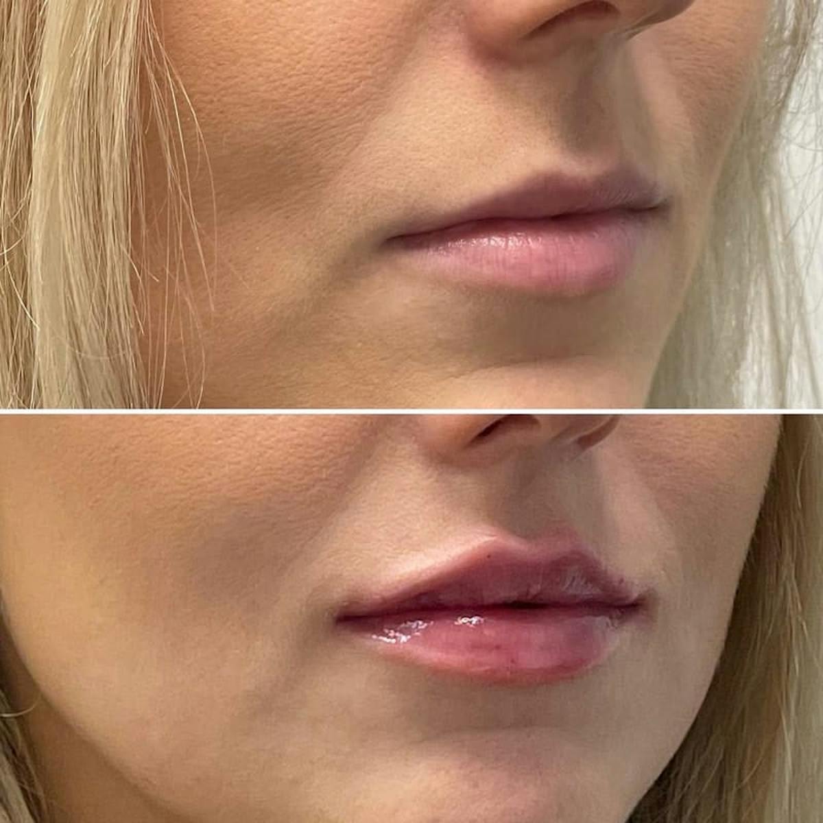 Lip Injections Before & After Gallery - Patient 331766 - Image 1
