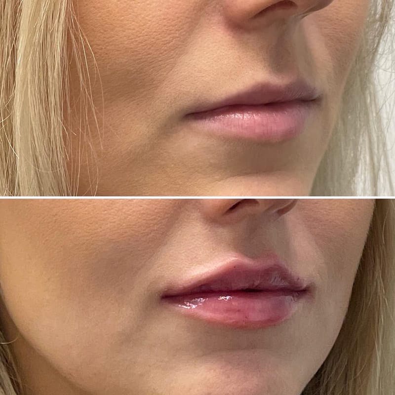 Lip Injections Before & After Gallery - Patient 331766 - Image 1