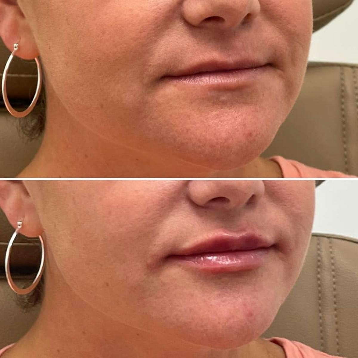 Lip Injections Before & After Gallery - Patient 279552 - Image 2