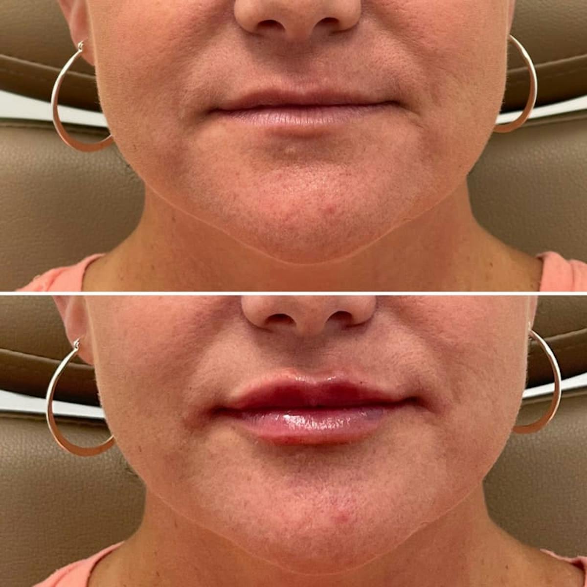 Lip Injections Before & After Gallery - Patient 279552 - Image 1
