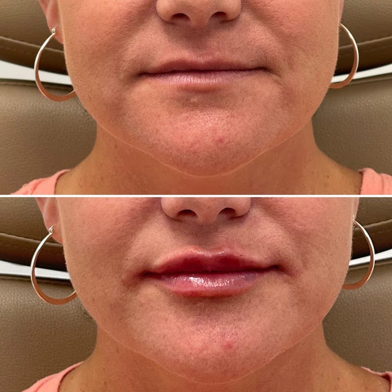 Lip Injections Before & After Gallery - Patient 279552 - Image 1