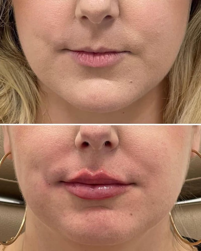 Lip Injections Before & After Gallery - Patient 854855 - Image 1
