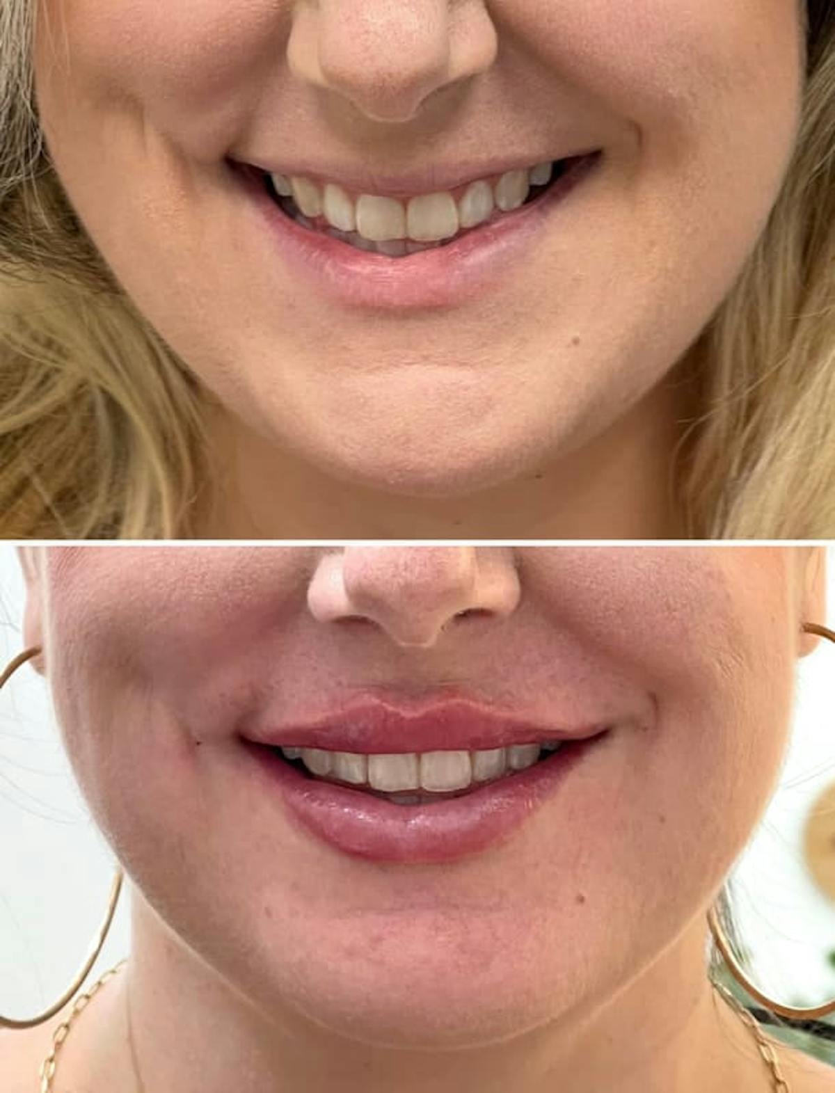 Lip Injections Before & After Gallery - Patient 854855 - Image 2