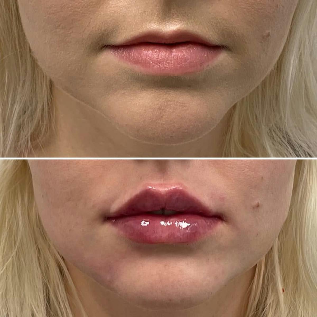 Lip Injections Before & After Gallery - Patient 264797 - Image 1