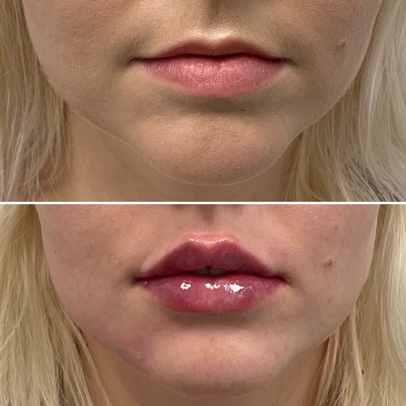 Lip Injections Before & After Gallery - Patient 264797 - Image 1