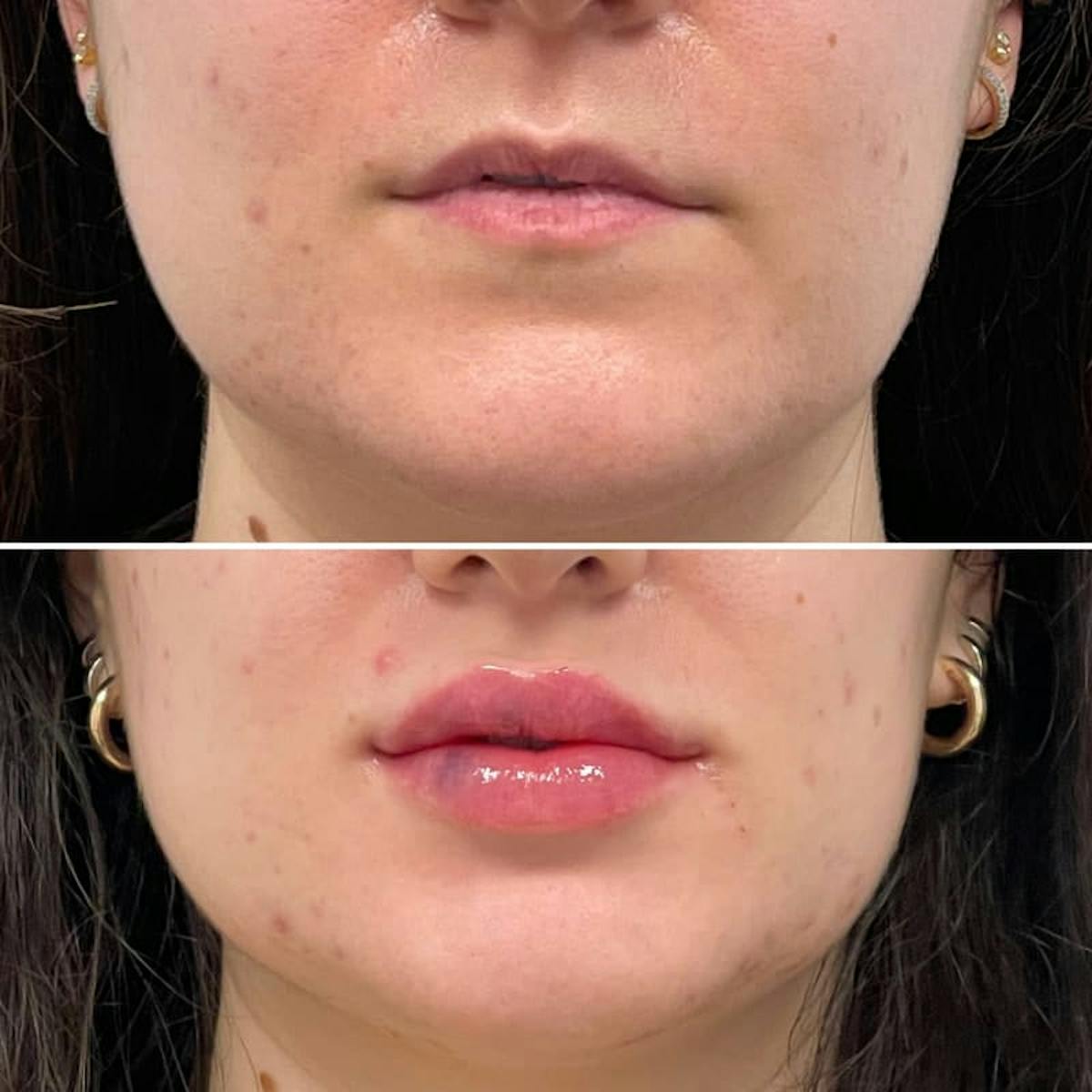 Lip Injections Before & After Gallery - Patient 198810 - Image 1