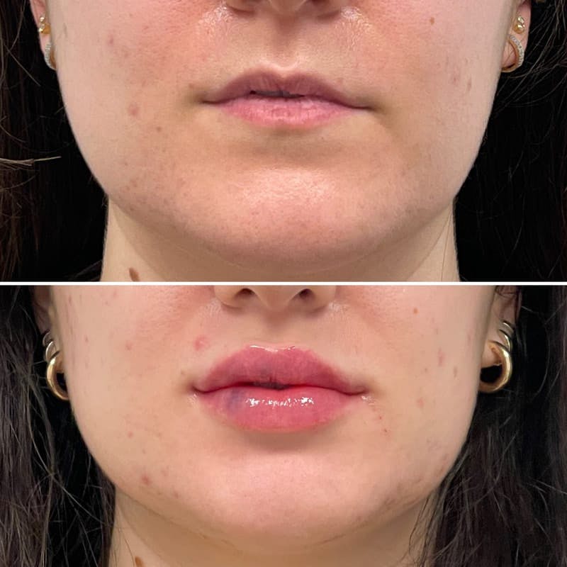 Lip Injections Before & After Gallery - Patient 198810 - Image 1