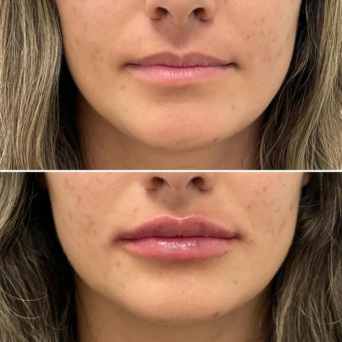 Lip Injections Before & After Gallery - Patient 661091 - Image 1
