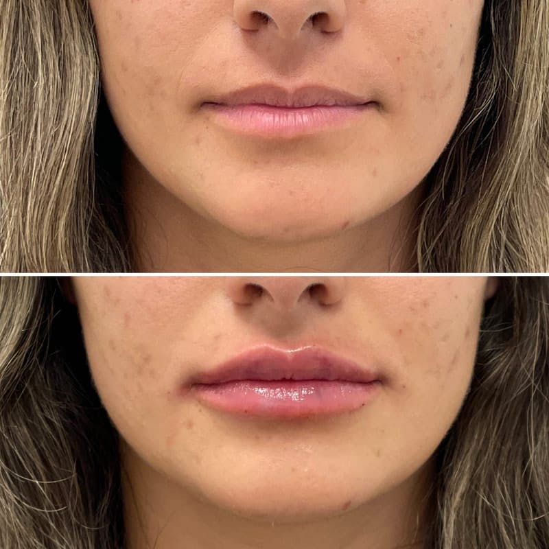 Lip Injections Before & After Gallery - Patient 661091 - Image 1