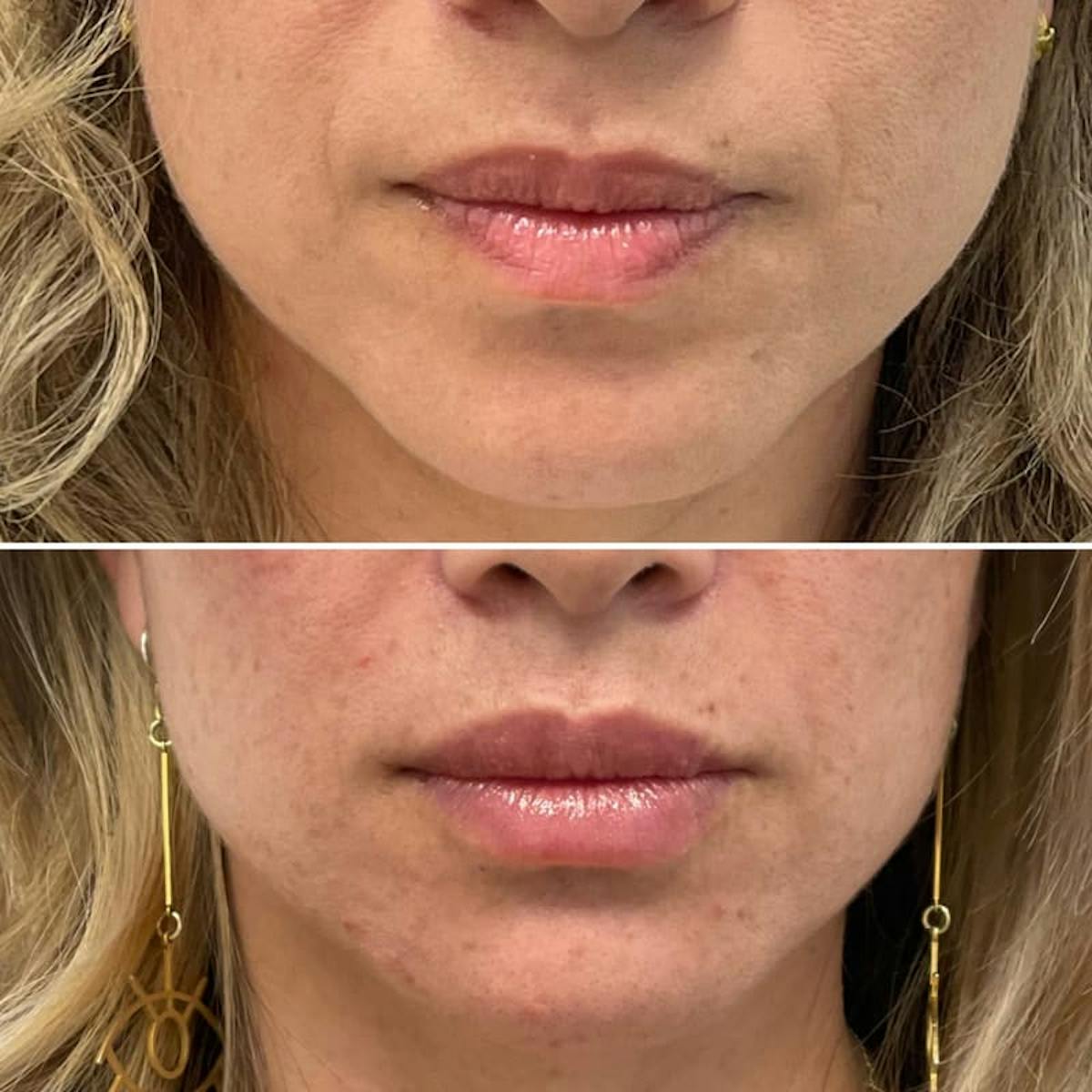 Lip Injections Before & After Gallery - Patient 204465 - Image 1