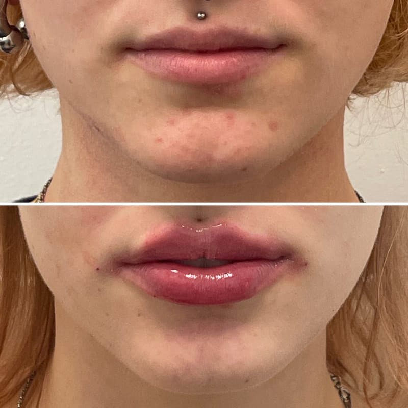 Lip Injections Before & After Gallery - Patient 359659 - Image 1