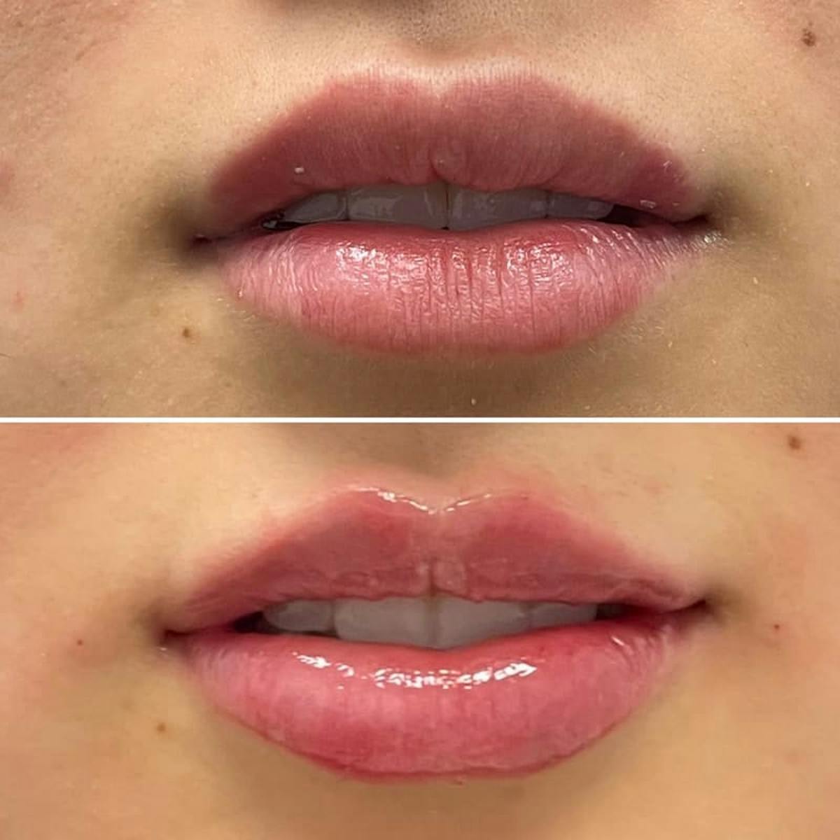 Lip Injections Before & After Gallery - Patient 899943 - Image 1