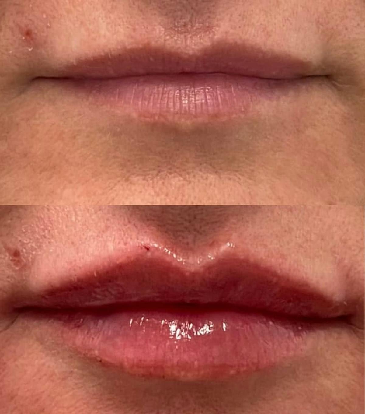 Lip Injections Before & After Gallery - Patient 456428 - Image 1