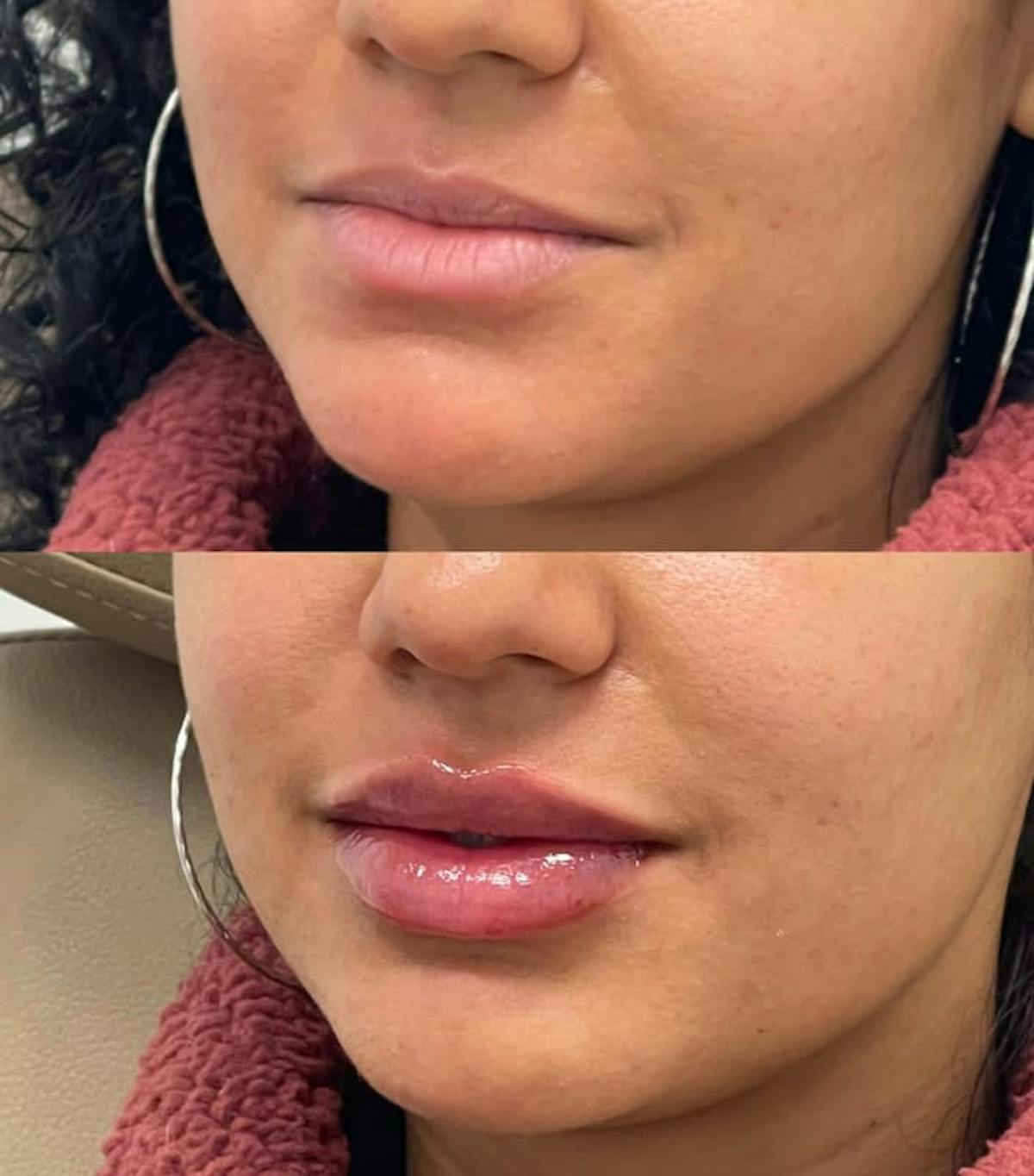 Lip Injections Before & After Gallery - Patient 407084 - Image 1
