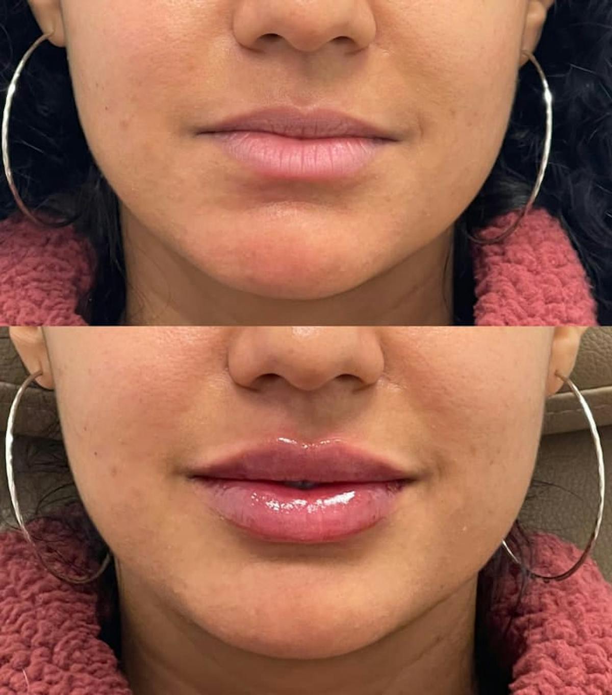 Lip Injections Before & After Gallery - Patient 407084 - Image 2
