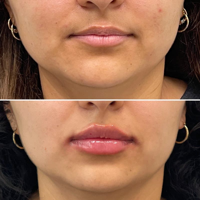 Lip Injections Before & After Gallery - Patient 370921 - Image 1