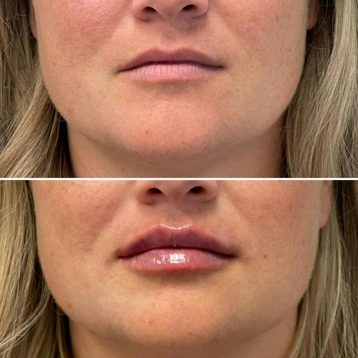 Lip Injections Before & After Gallery - Patient 392624 - Image 1