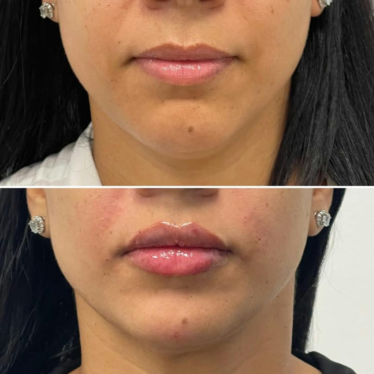 Lip Injections Before & After Gallery - Patient 192241 - Image 1