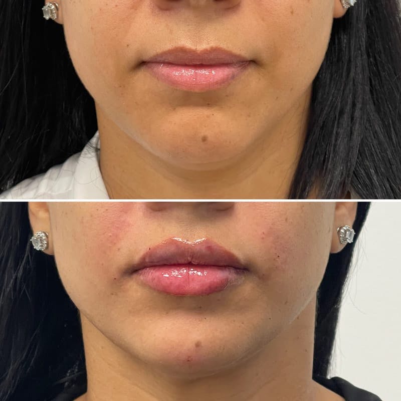 Lip Injections Before & After Gallery - Patient 192241 - Image 1