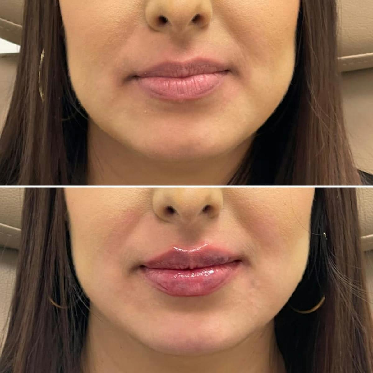 Lip Injections Before & After Gallery - Patient 121047 - Image 1