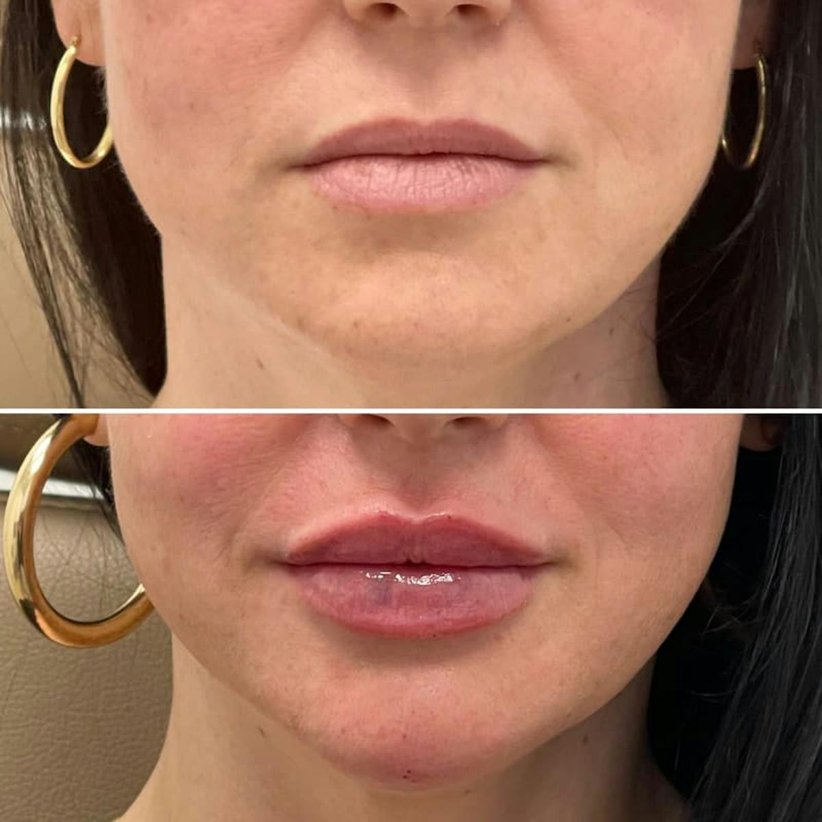 Lip Injections Before & After Gallery - Patient 216218 - Image 1