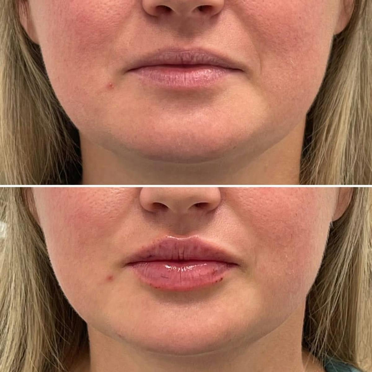 Lip Injections Before & After Gallery - Patient 391711 - Image 1