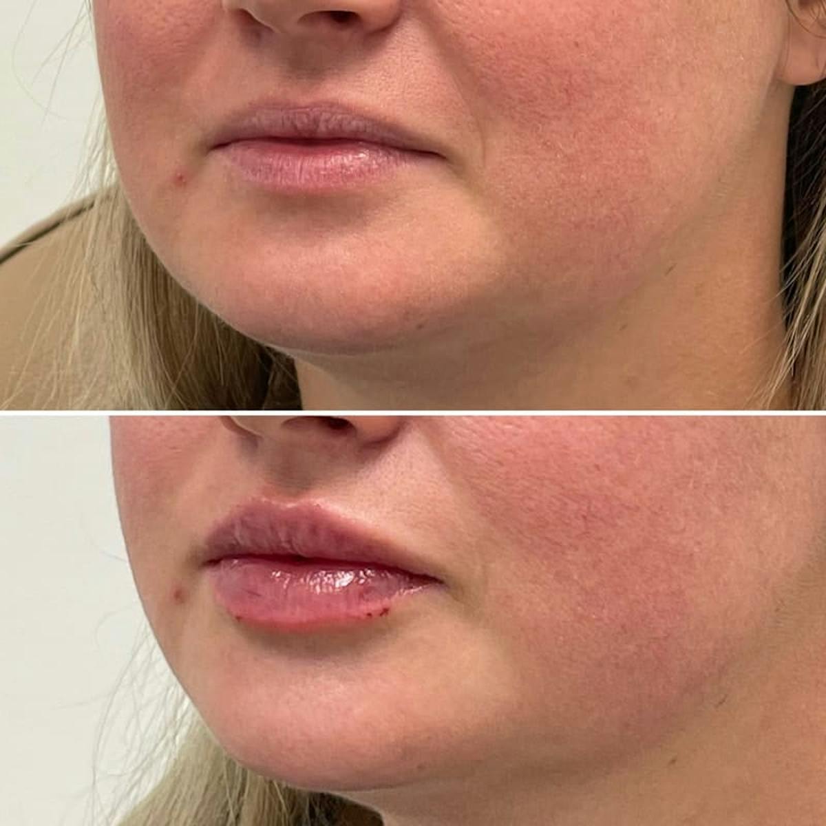 Lip Injections Before & After Gallery - Patient 391711 - Image 2