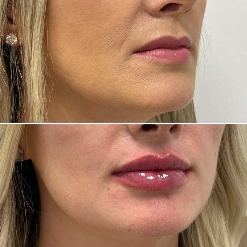 Lip Injections Before & After Gallery - Patient 486107 - Image 1