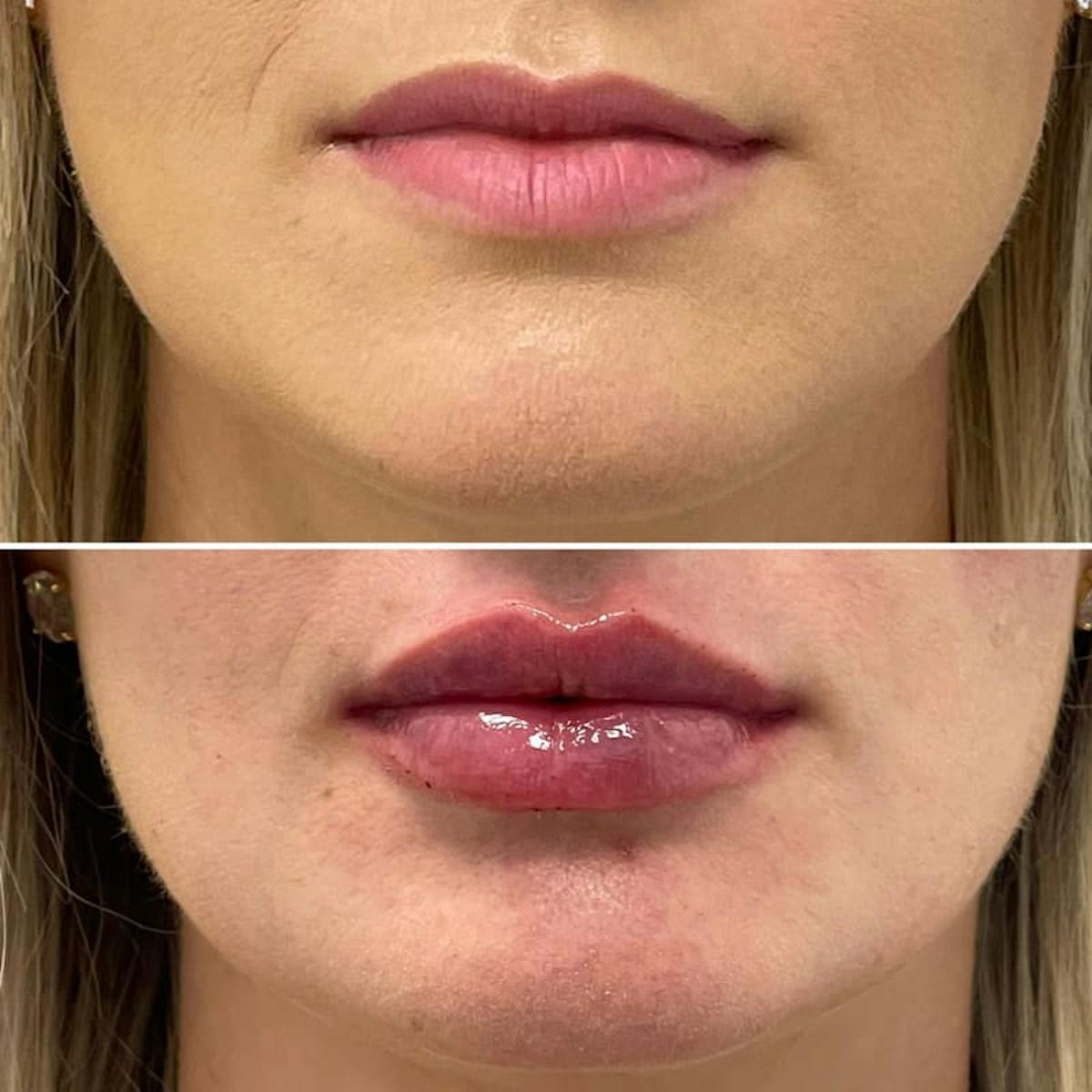 Lip Injections Before & After Gallery - Patient 486107 - Image 2