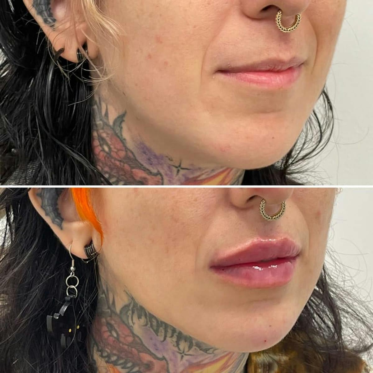 Lip Injections Before & After Gallery - Patient 418827 - Image 1