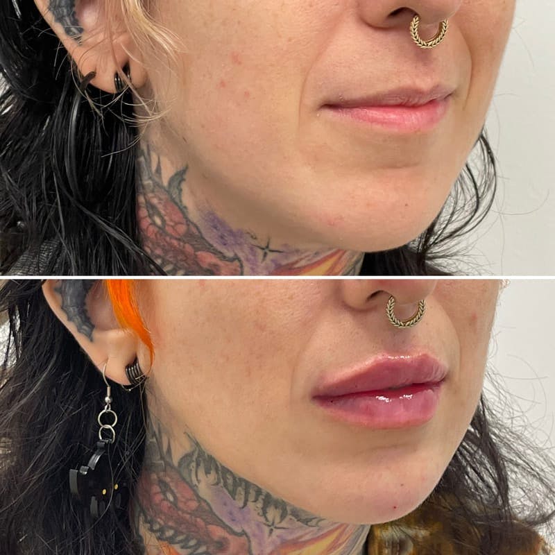 Lip Injections Before & After Gallery - Patient 418827 - Image 1