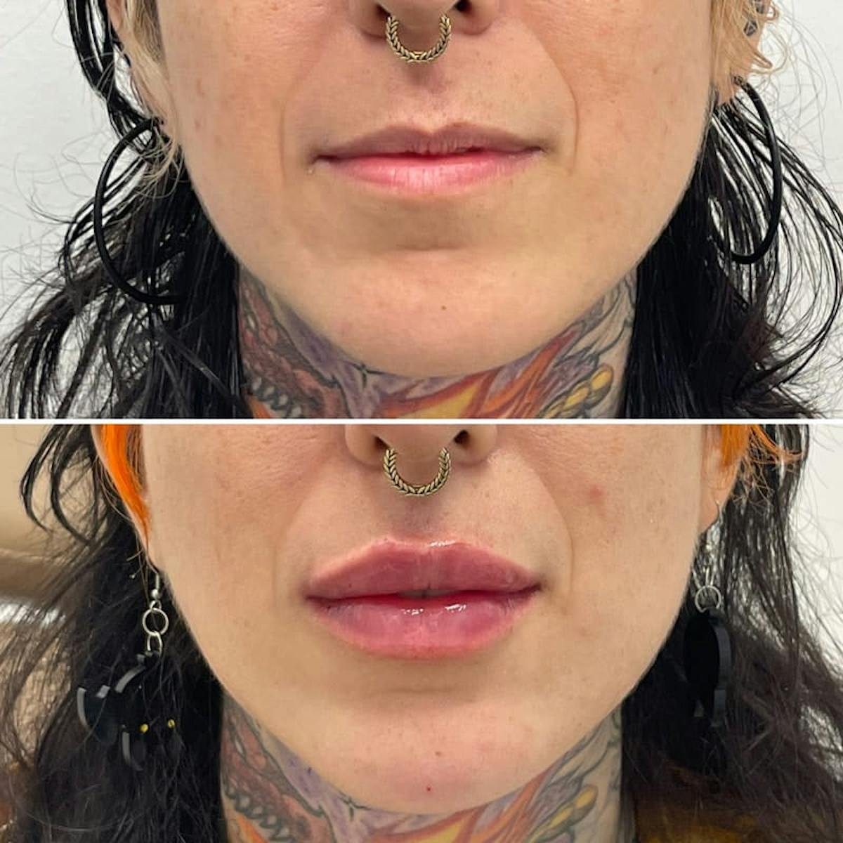 Lip Injections Before & After Gallery - Patient 418827 - Image 2
