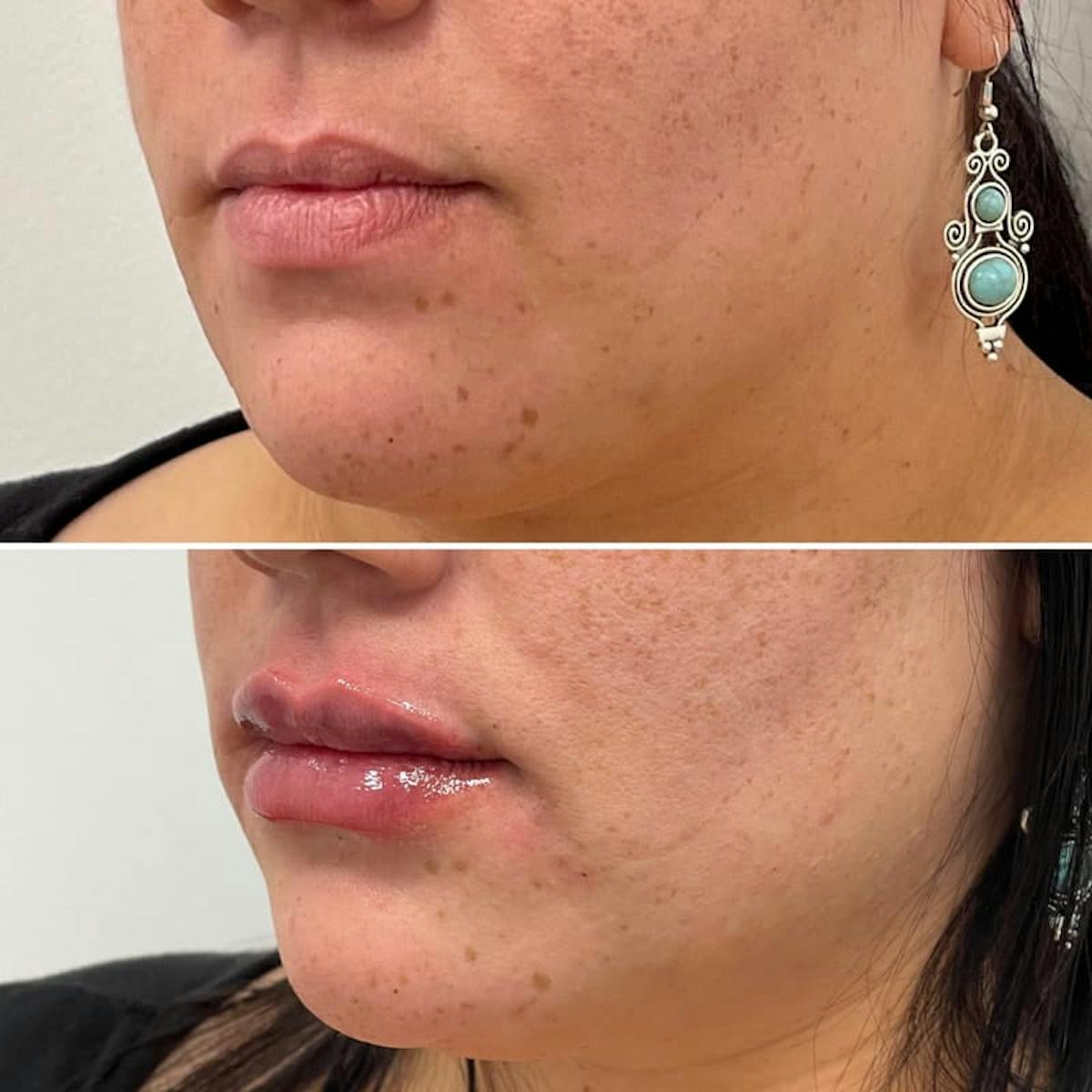 Lip Injections Before & After Gallery - Patient 326309 - Image 1