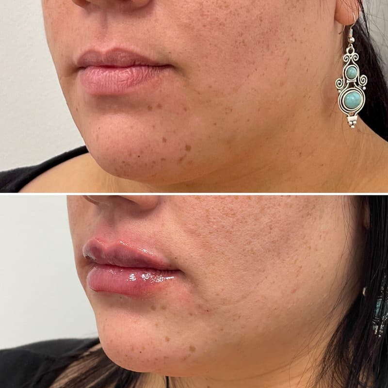 Lip Injections Before & After Gallery - Patient 326309 - Image 1