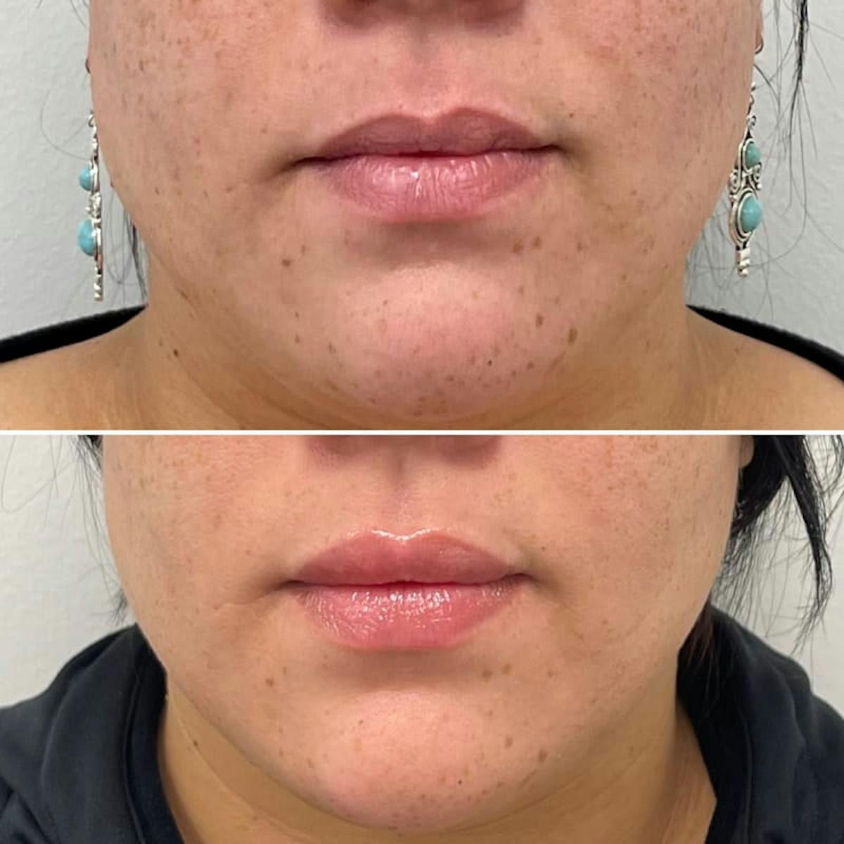 Lip Injections Before & After Gallery - Patient 326309 - Image 2