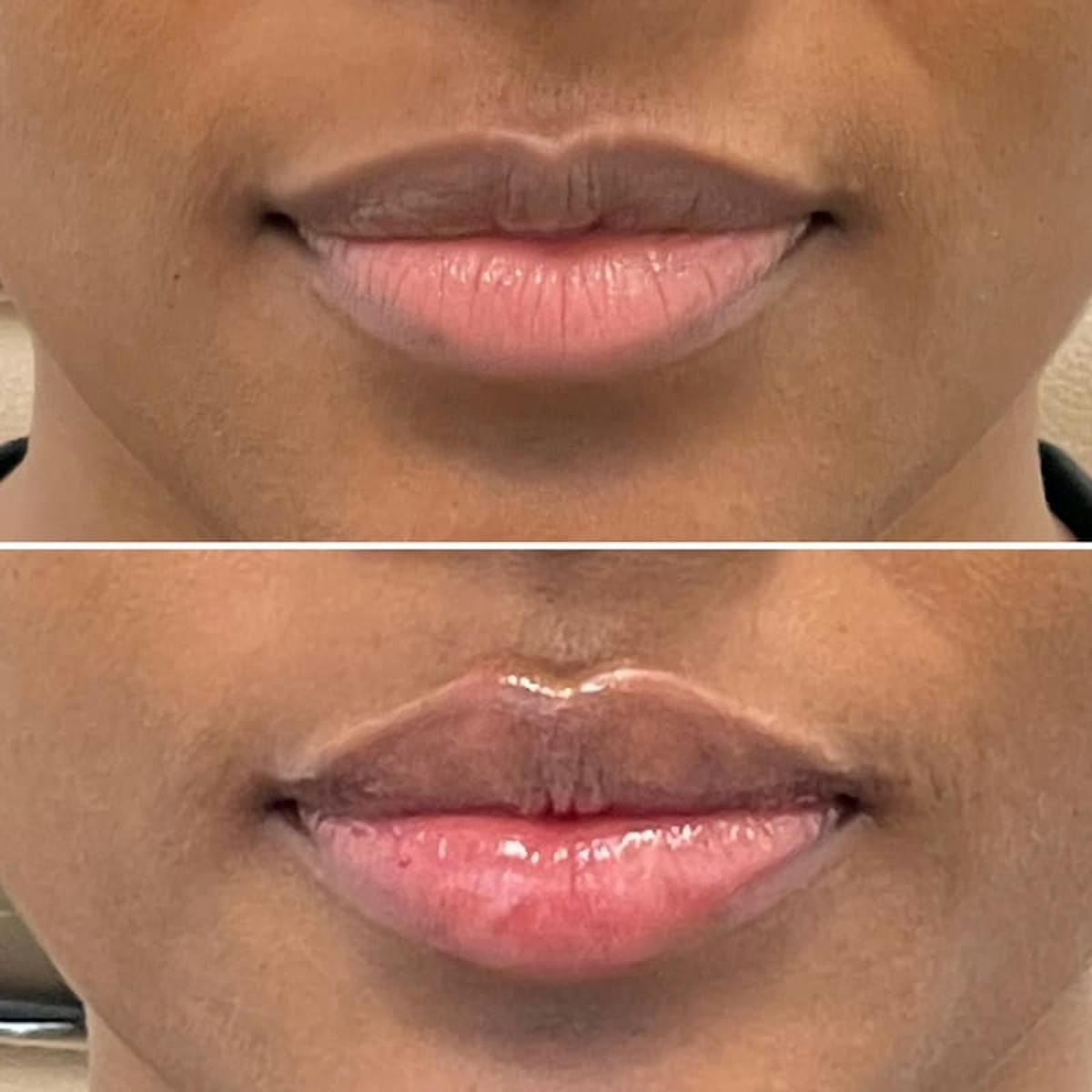 Lip Injections Before & After Gallery - Patient 299341 - Image 1