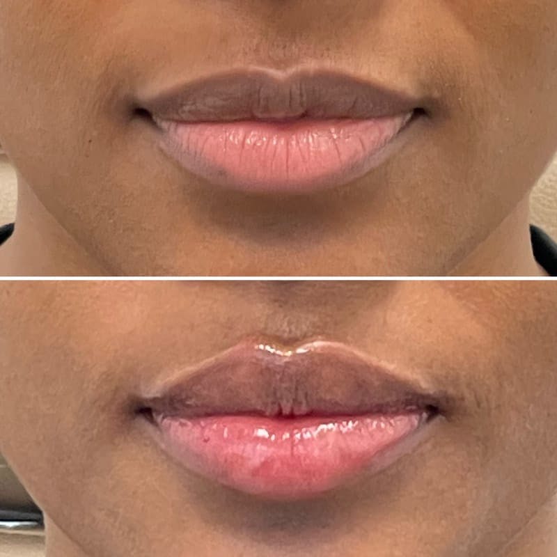 Lip Injections Before & After Gallery - Patient 299341 - Image 1