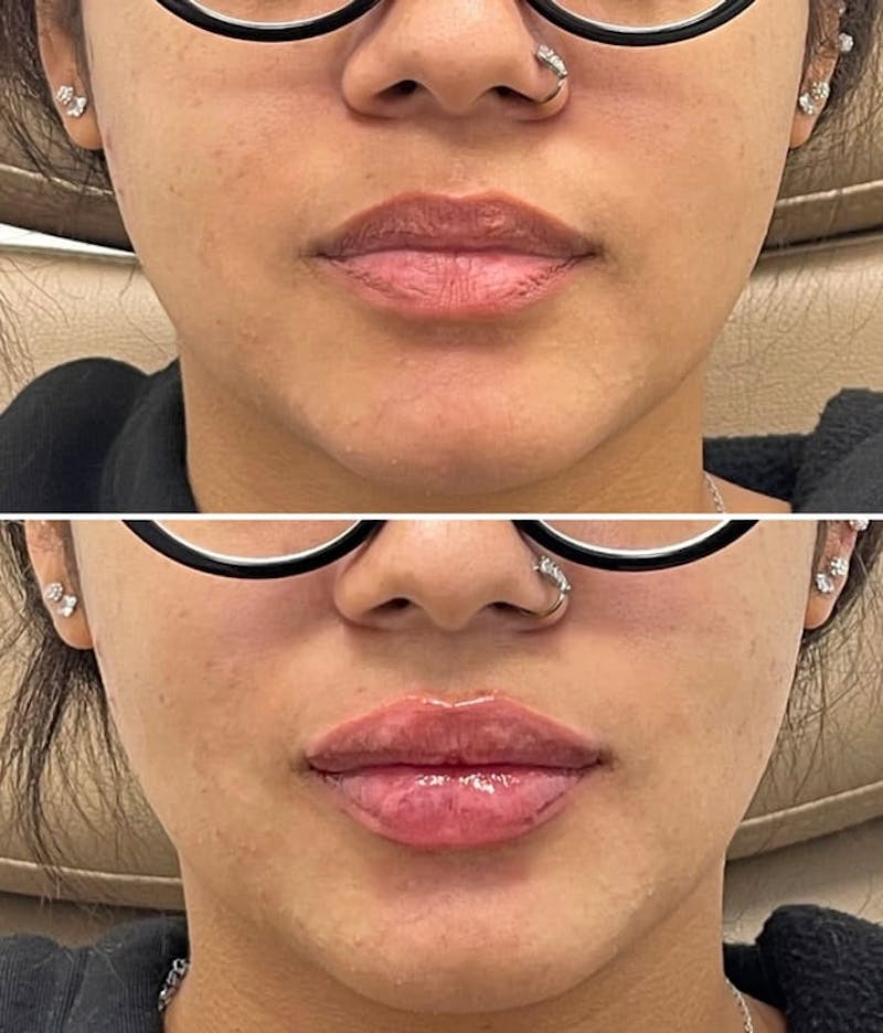 Lip Injections Before & After Gallery - Patient 813099 - Image 1