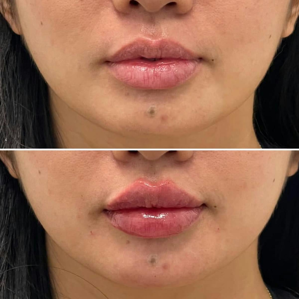Lip Injections Before & After Gallery - Patient 105797 - Image 1