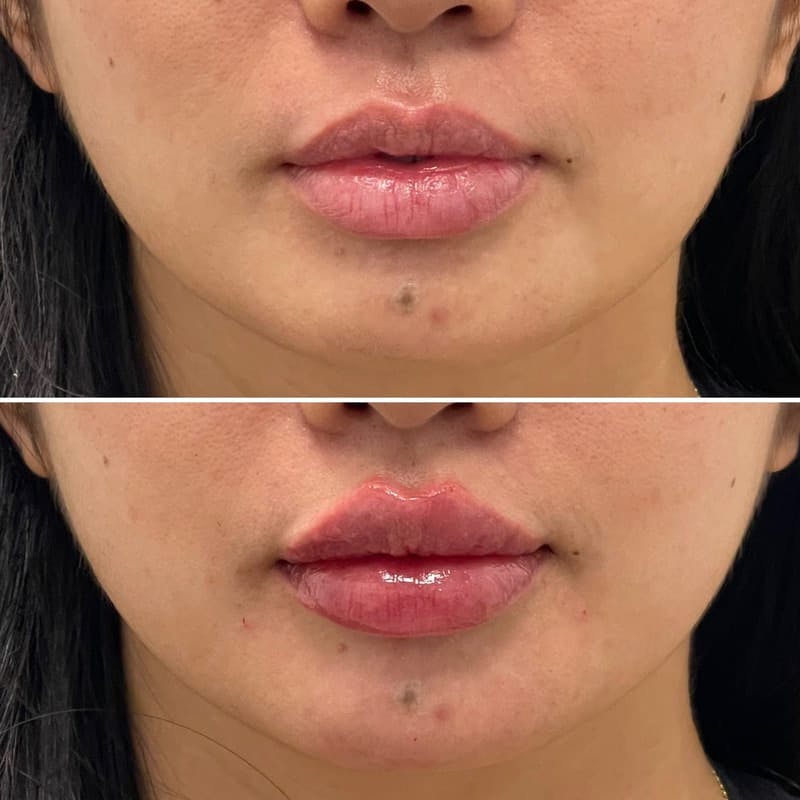 Lip Injections Before & After Gallery - Patient 105797 - Image 1