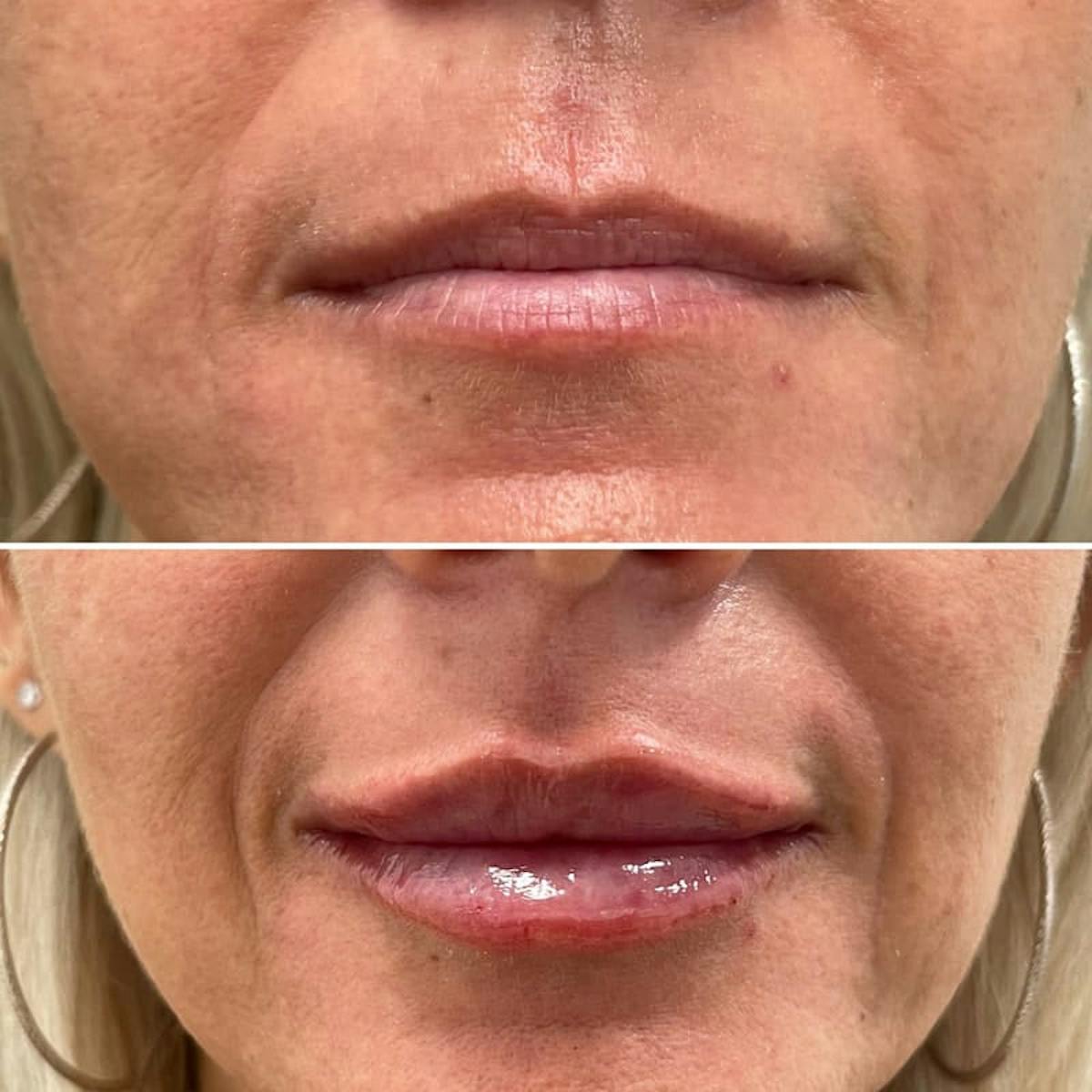 Lip Injections Before & After Gallery - Patient 371646 - Image 1