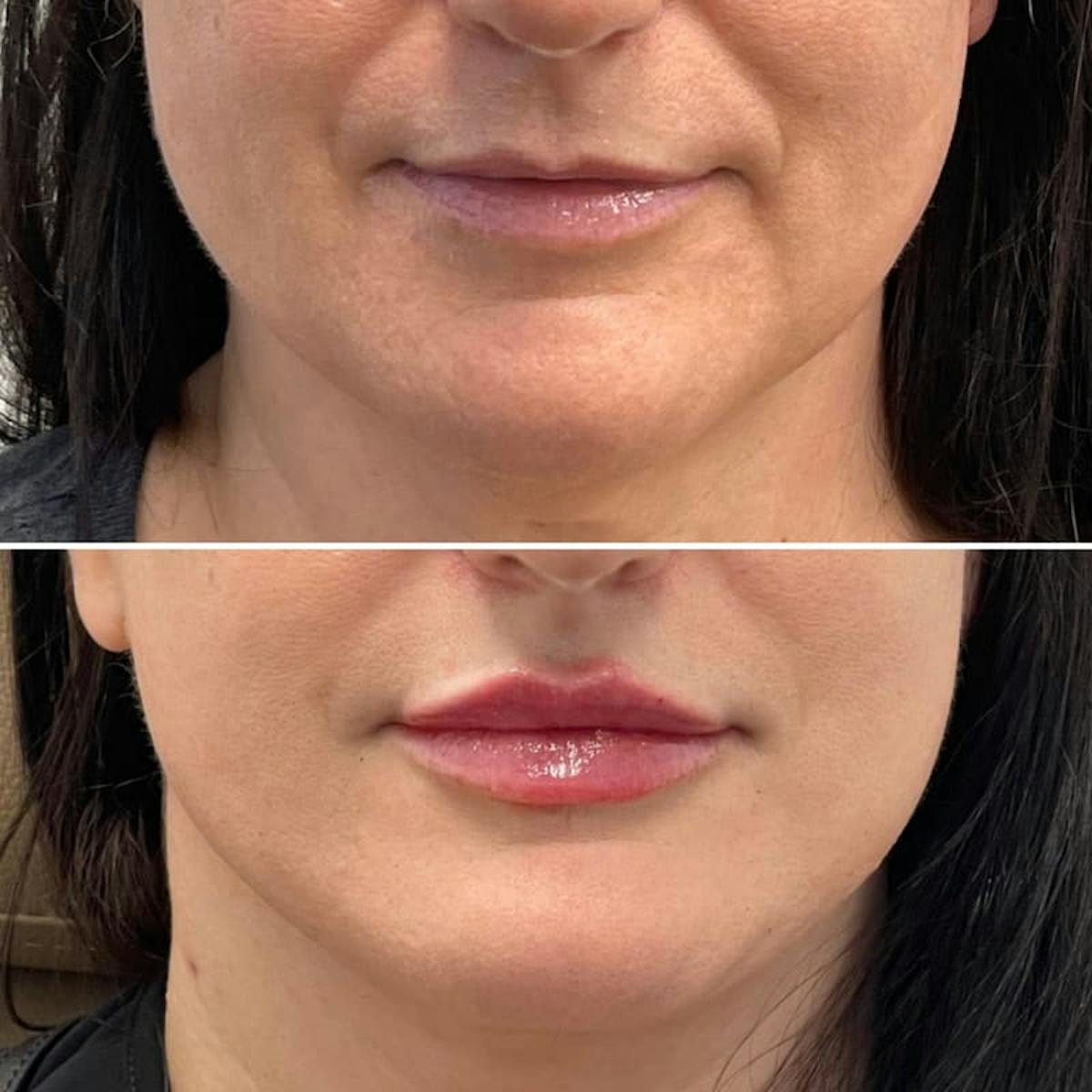 Lip Injections Before & After Gallery - Patient 151162 - Image 1