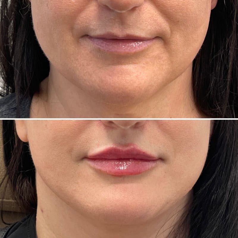 Lip Injections Before & After Gallery - Patient 151162 - Image 1