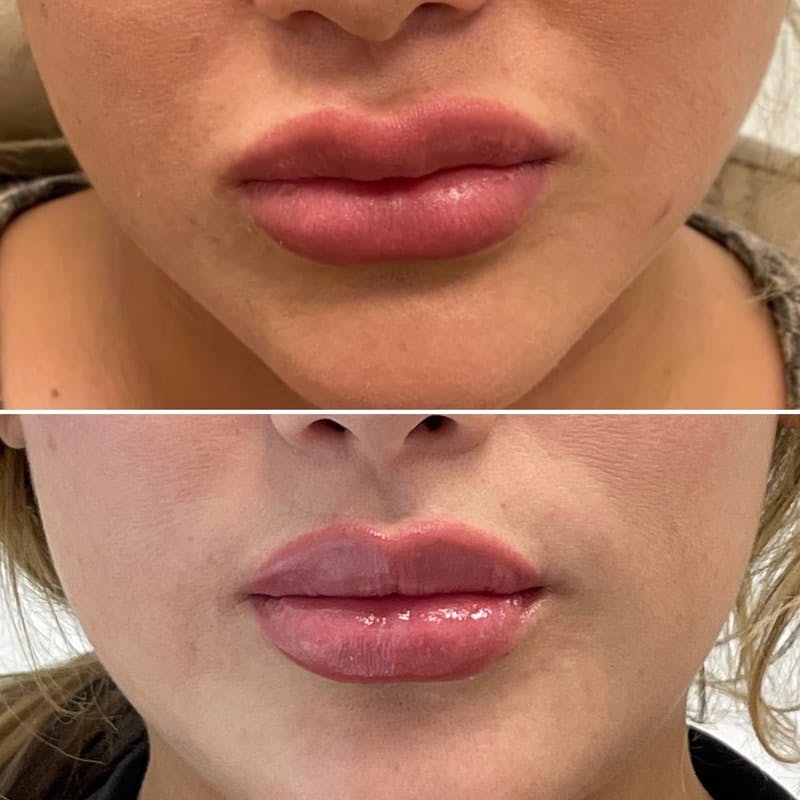 Lip Injections Before & After Gallery - Patient 398188 - Image 1