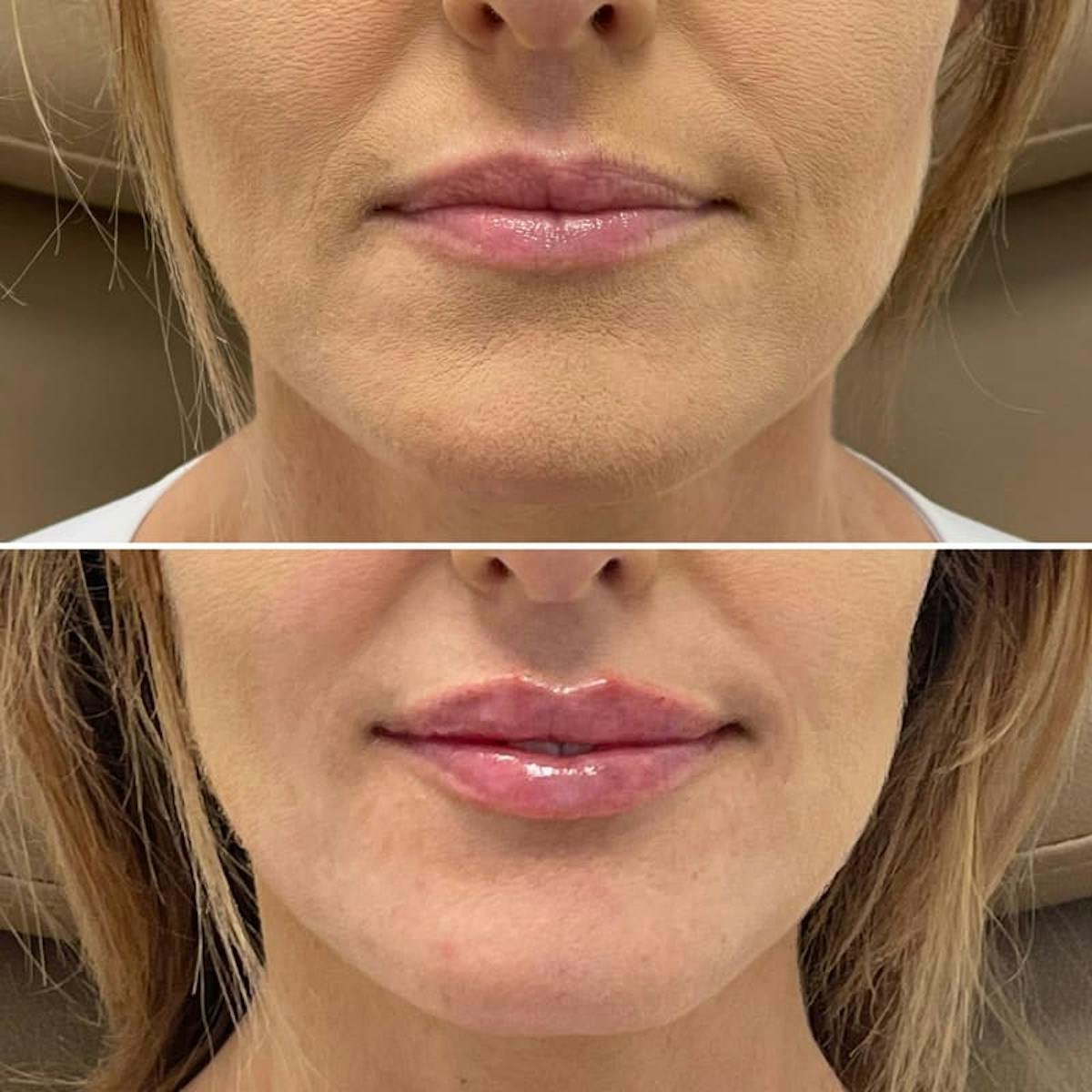 Lip Injections Before & After Gallery - Patient 338584 - Image 1