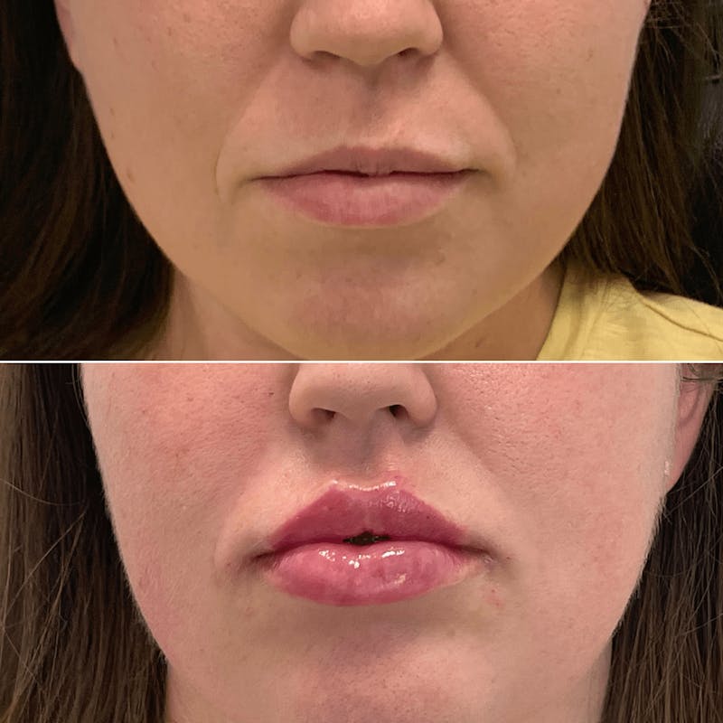Lip Injections Before & After Gallery - Patient 189687 - Image 1
