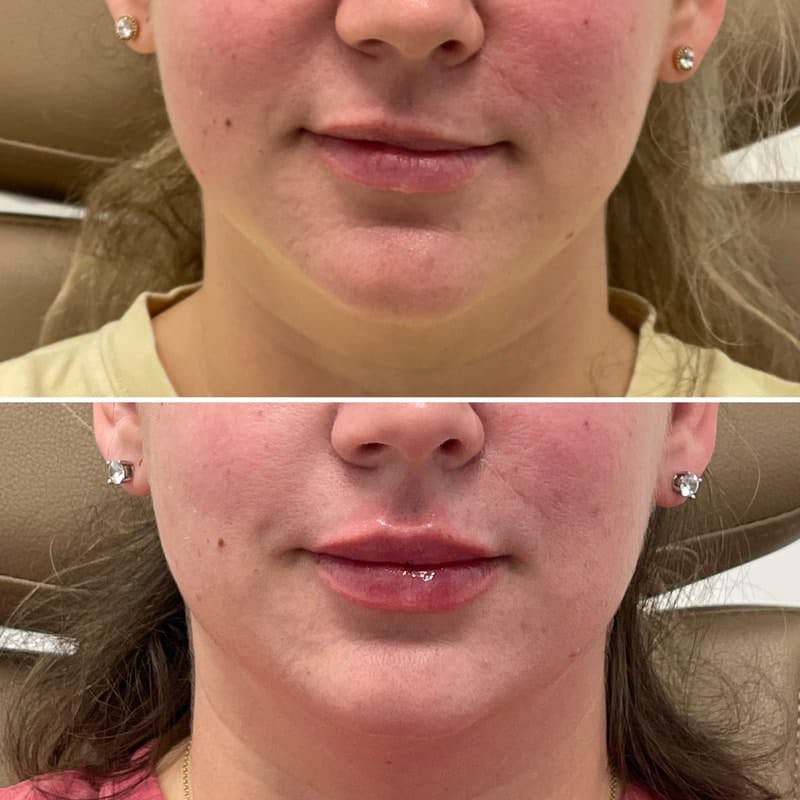 Lip Injections Before & After Gallery - Patient 313175 - Image 1